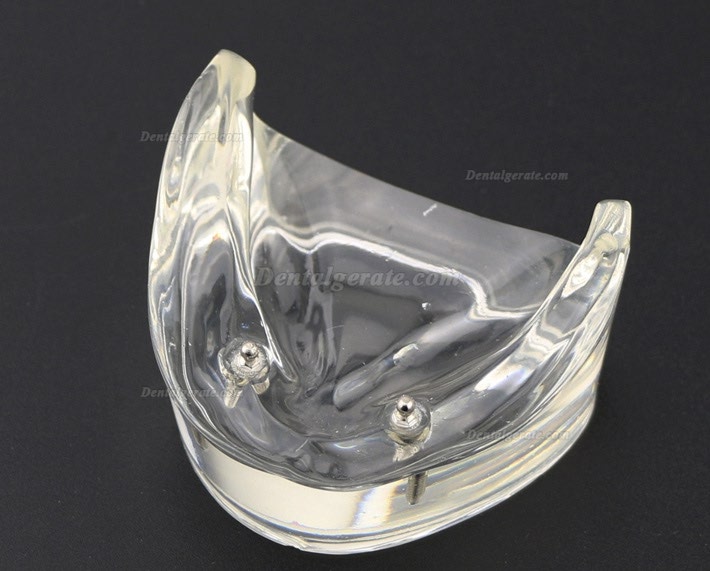 Modell f&uuml;r zahn&auml;rztliche Oberz&auml;hne Overdenture Superior 4 Implantate Demo Modell 6001 02